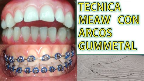 La técnica Meaw con arcos gummetal para Ortodoncia Difícil YouTube