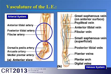 Peripheral Arterial Disease Critical Limb Ischemia Pedal Approach