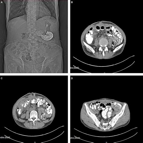 Frontiers Abdominal Cocoon With Intestinal Perforation A Case Report