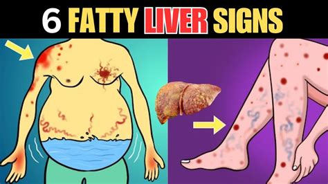 6 Signs That Could Indicate Fatty Liver Disease Youtube