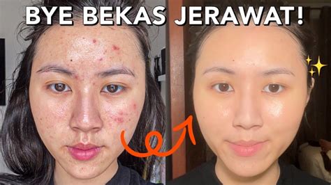 Cara Menghilangkan Bekas Jerawat Pih Tanpa Skincare Bye Bekas Jerawat Dan Kulit Kusam Youtube