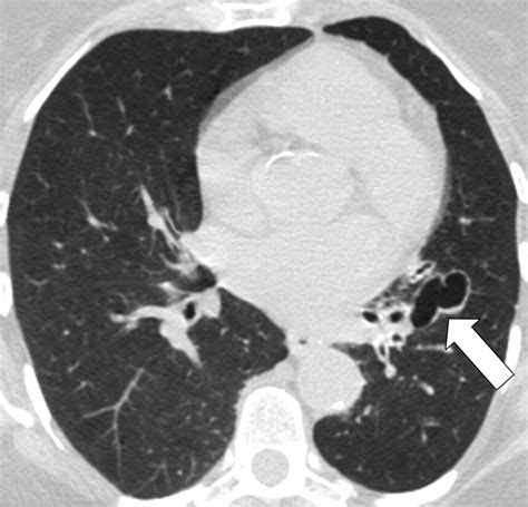 Bronchiectasis Ajr