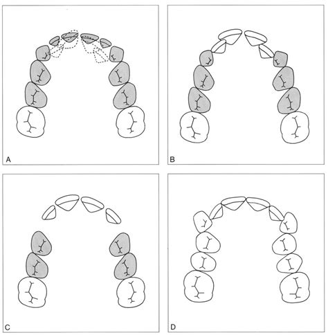 9 Premature Loss And Extraction Of Deciduous Incisors And Canines