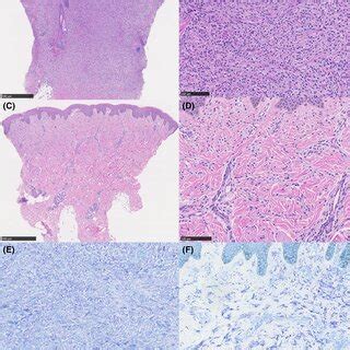 Histological observations of the mastocytoma and maculopapular ...