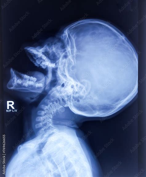 X Ray Of Nasopharynx Lateral View Show Enlarged Adenoid Small Lobulated Dense Homogeneous