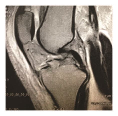 Magnetic Resonance Imaging Showing Intact Pcl A Avulsion Of The Download Scientific Diagram