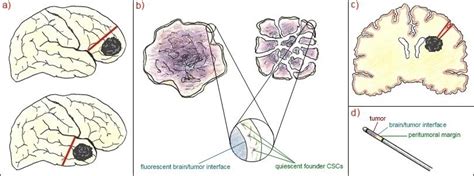 Ethical Methods As Part Of Normal Glioblastoma Surgery To Sample The