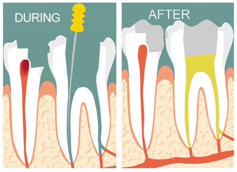 Root Canal Explained Waverley Oaks Dental