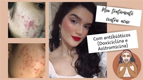 Meu Tratamento Contra Acne Doxiciclina Azitromicina Adacne Clin