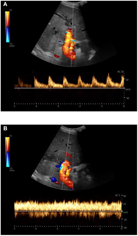 Doppler Sonography In Triplex Technique B Image Color Doppler Download Scientific Diagram