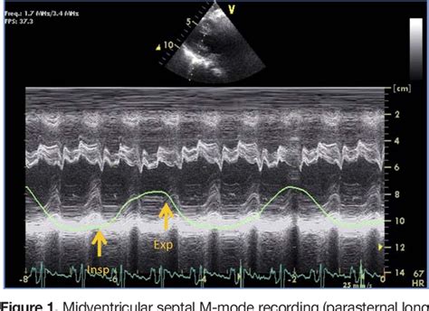 Figure 1 From Echocardiographic Diagnosis Of Constrictive Pericarditis