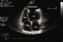 emDOCs.net – Emergency Medicine EducationECG Pointers: Post Myocardial ...