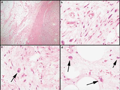 Features Of Atypical Spindle Cell Proliferations A Fibrous Septa