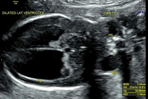 Semilobar holoprosencephaly | Medical ultrasound, Obstetric ultrasound ...