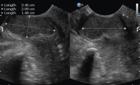 Anterior Vaginal Wall Epitheloid Leiomyoma A Case Report