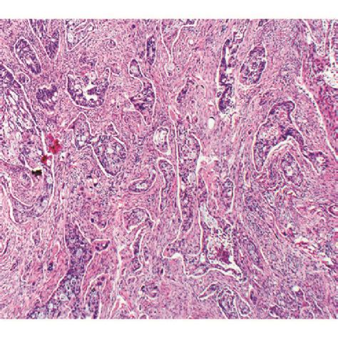 Hande Stained Sections Of Grade 2 Moderately Differentiated Download Scientific Diagram