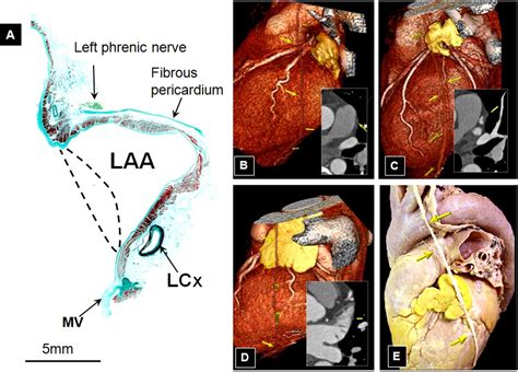 Left Atrial Appendage Anatomy And Imaging Landmarks Pertinent To