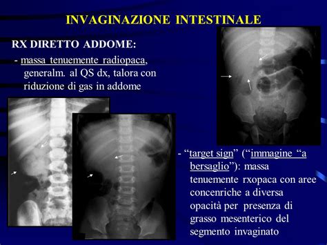 LIMAGING NELLE OCCLUSIONI INTESTINALI DEL NEONATO E DEL LATTANTE Ppt