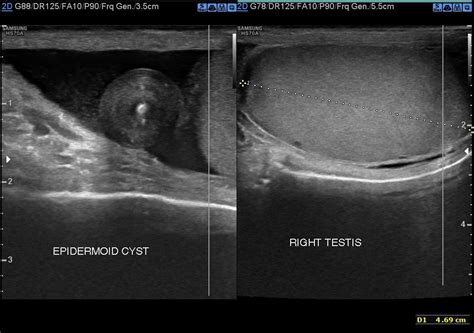 Extratesticular Intrascrotal Epidermoid Cyst Eurorad