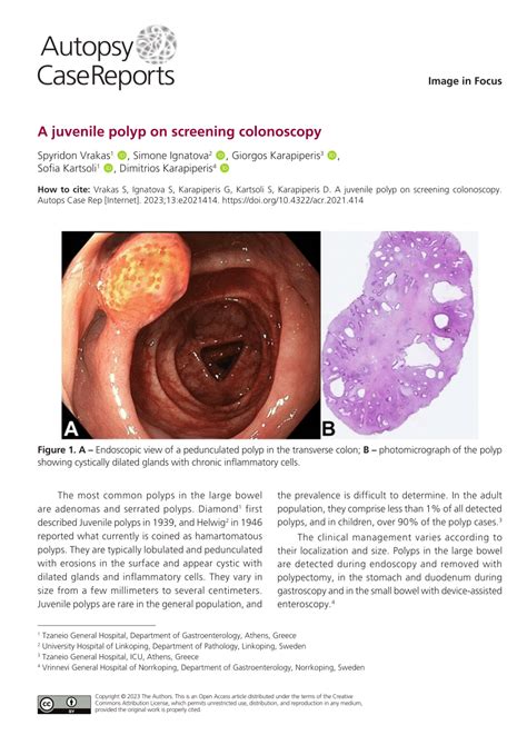 Pdf A Juvenile Polyp On Screening Colonoscopy