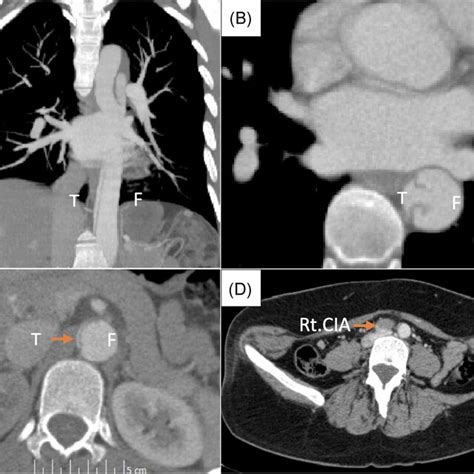 Preoperative Computed Tomography Scan Which Shows A Dissection Download Scientific Diagram