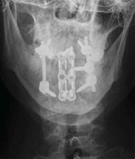 Follow Up A B A P And Lateral Radiographs Of The Cervical Spine Of