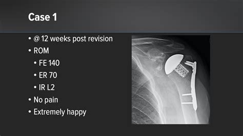 Arthrex Eclipse™ Stemless Shoulder Arthroplasty System Options For Care Following An Orif