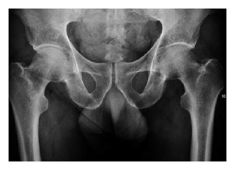 (a) X-ray of a patient with transient osteoporosis of the left hip ...