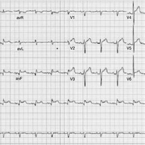 Twelve Lead Electrocardiogram Ekg Showing St Segment Elevations In