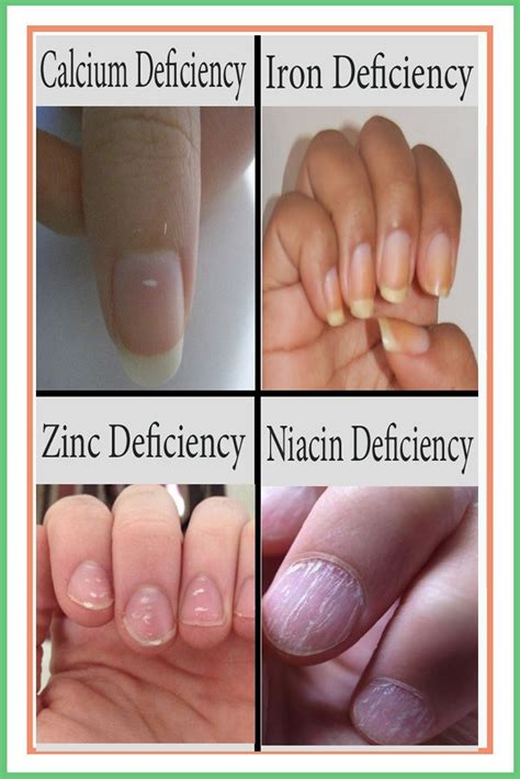 48 Nails Zinc Deficiency | Noviyandipainter