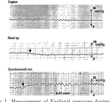 Table From Continuation Measurement Of Thoracic Epidural Pressure