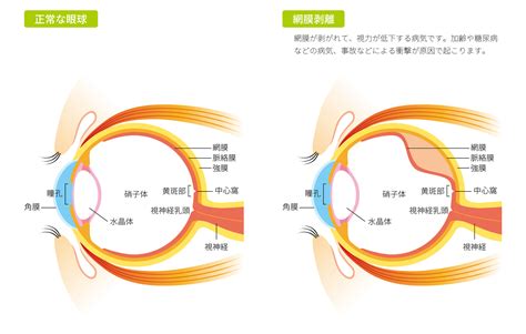 網膜剥離の基礎知識 中日新聞LINKED