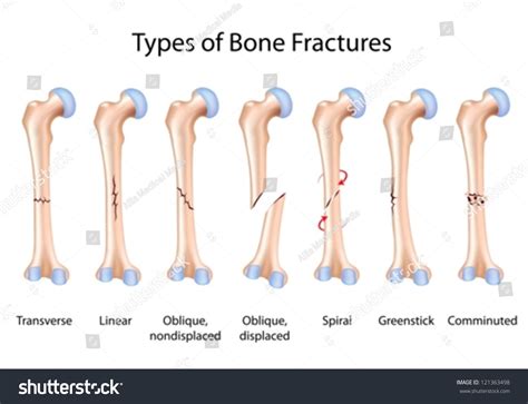 Comminuted Fracture Diagram