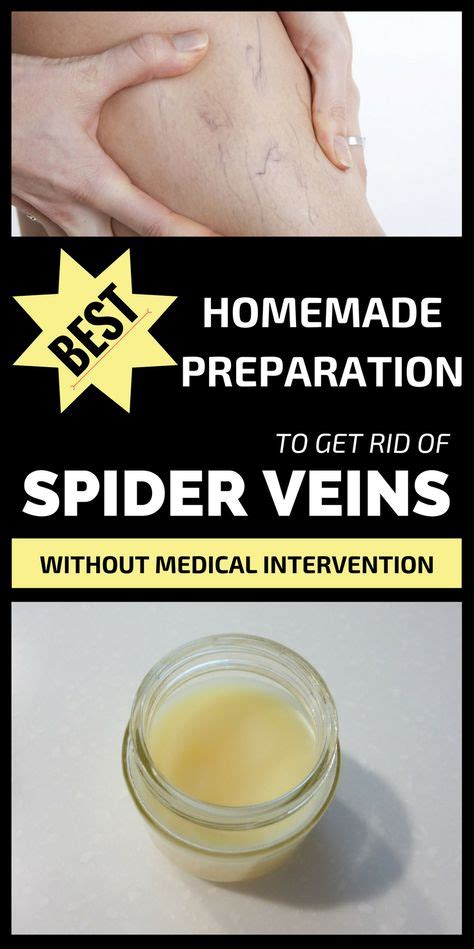 Best Homemade Preparation To Get Rid Of Spider Veins Without Medical Intervention Varicose