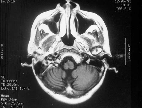 Cranial Mri Of Case A Showing Prominent Cerebellar Folia T Weighted