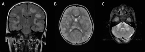 Adem Disease Causes Signs Symptoms Diagnosis Treatment And Prognosis