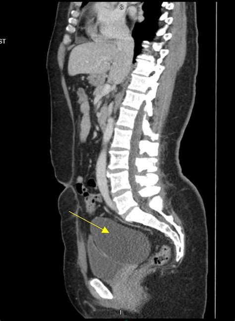 Sagittal view of left adnexal cyst (yellow arrow) on CT abdomen and ...