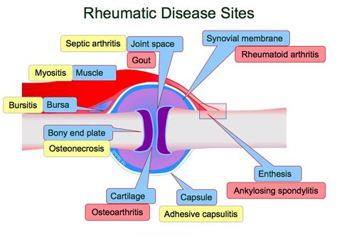 Rheumatoid Arthritis My Wiki