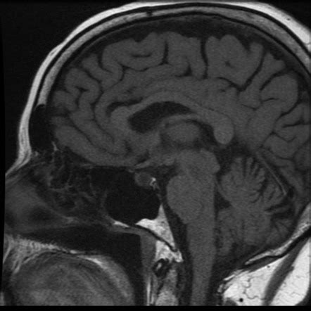 Pituitary Metastasis Image Radiopaedia Org