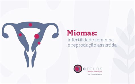 Miomas infertilidade feminina e reprodução assistida