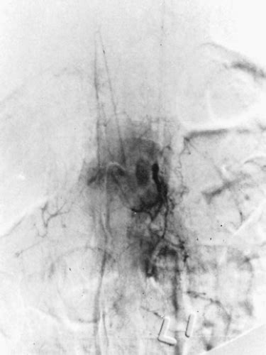 Benign and Malignant Neurogenic Tumors of the Mediastinum in Children ...