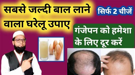 Ganjepan Ko Kaise Dur Karen Hair Fall Solution At Home Balo Ka