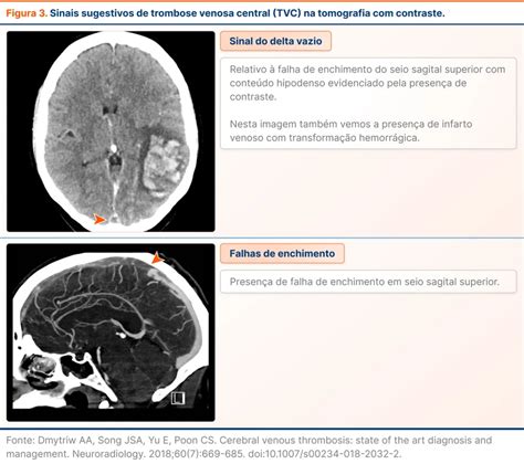 Diretriz De Trombose Venosa Cerebral Da AHA ASA De 2024 Guia TdC