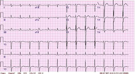 Non-Specific Interventricular Conduction Delay ECG 1 | LearntheHeart.com