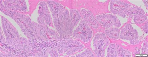 Human Pancreas Cancer (Adenocarcinoma) FFPE Sections