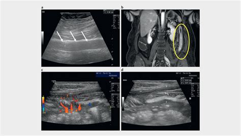 5.9 year old patient with left-sided colitis: ) longitudinal US image... | Download Scientific ...