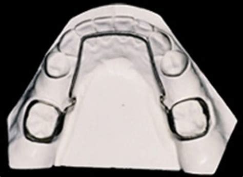 Manejo De Espacio De Leeway En Dentición Mixta Reporte De Caso Clínico