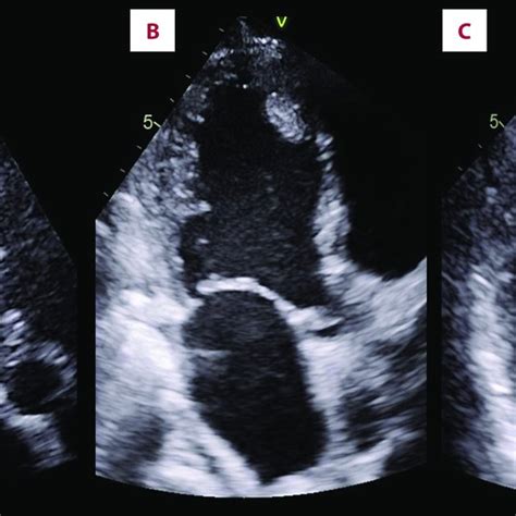 Apical Chamber Views On The Serial Transthoracic Echocardiograms A