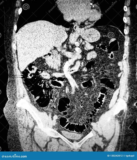 Virtual Colonoscopy Moderate Diverticulosis Ct Scan Stock Photography