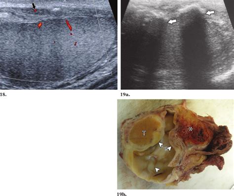 19 Diffuse Fibrous Pseudotumor Us Images In Two Patients Show